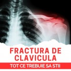 Fractura de Clavicula
